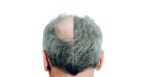 Laser Therapy Cap for Hair Loss