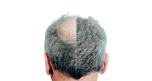 Load image into Gallery viewer, Laser Therapy Cap for Hair Loss